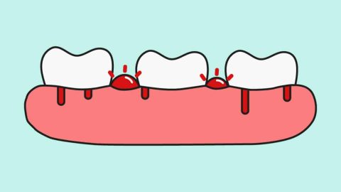 gingivitis bad breath