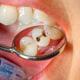 cavities and bad breath