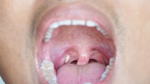 tonsil stones bad breath