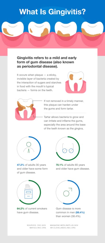 what is gingivitis and how treat it x