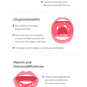 mouth sores what they are and how to get rid of them embed